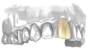 Perfect Smile veneers